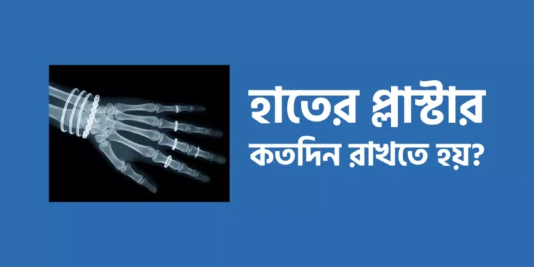 হাতের প্লাস্টার কতদিন রাখতে হয়?
