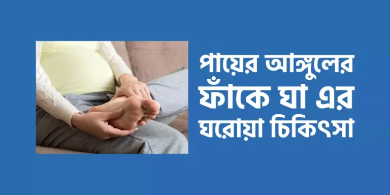 পায়ের আঙ্গুলের ফাঁকে ঘা এর ঘরোয়া চিকিৎসা