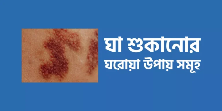 ঘা শুকানোর ঘরোয়া উপায় সমূহ